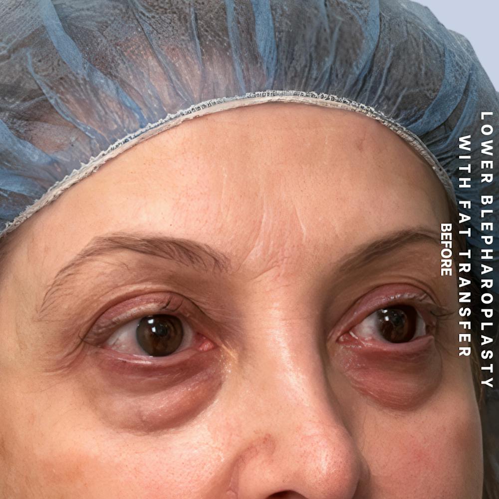 Eyes Before & After Gallery - Patient 160342 - Image 3