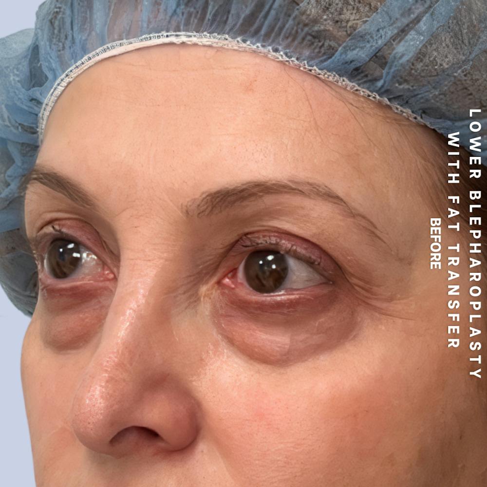 Eyes Before & After Gallery - Patient 160342 - Image 5