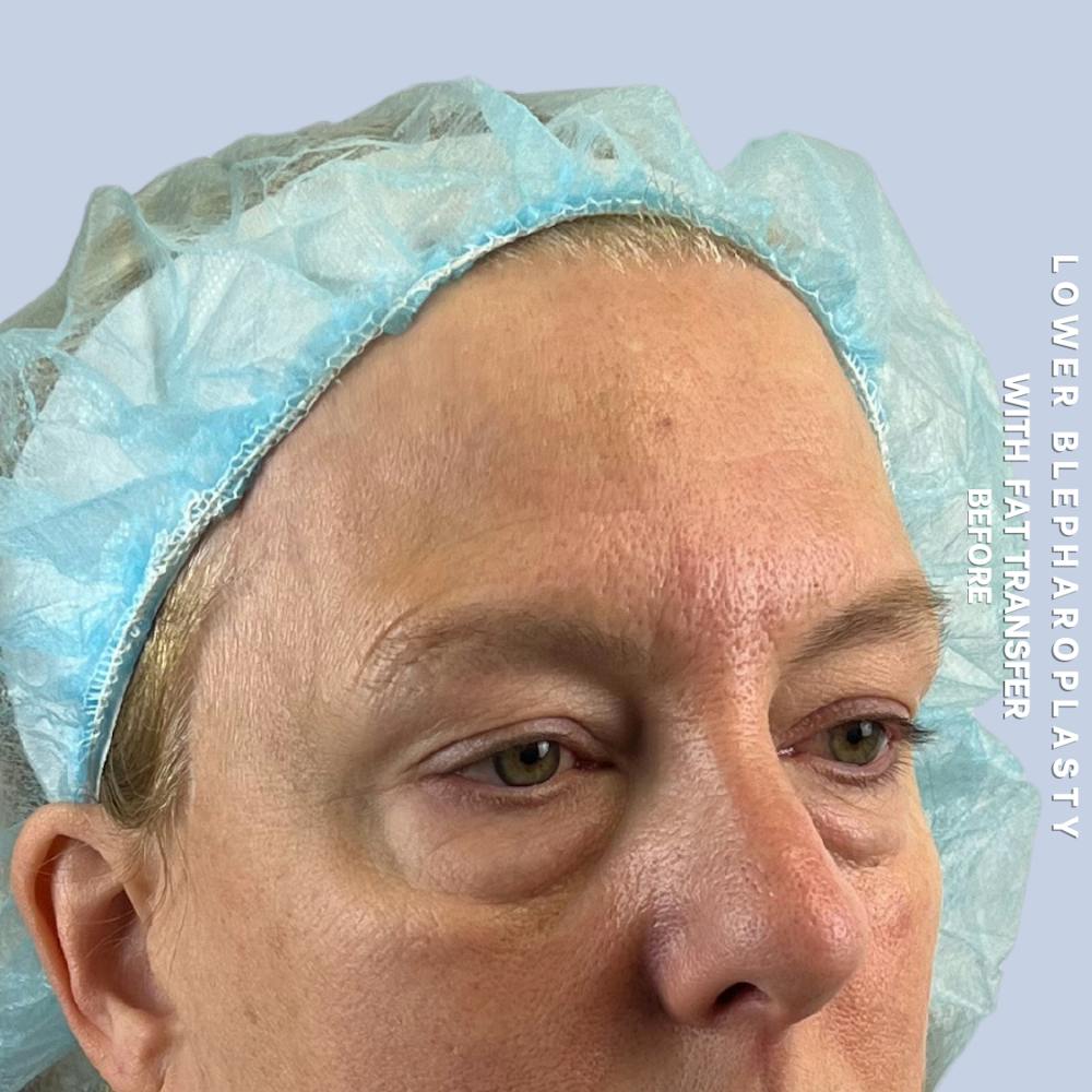 Eyes Before & After Gallery - Patient 227892 - Image 5