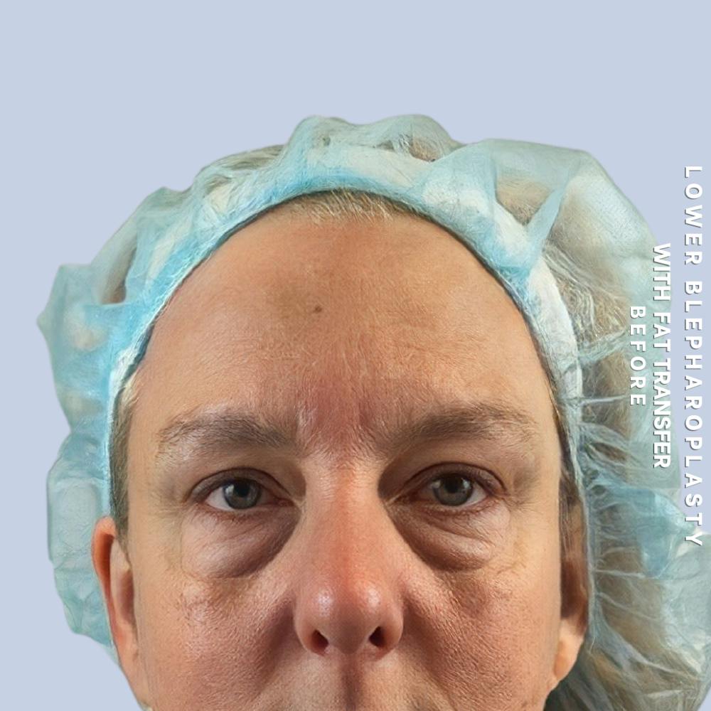 Eyes Before & After Gallery - Patient 227892 - Image 1