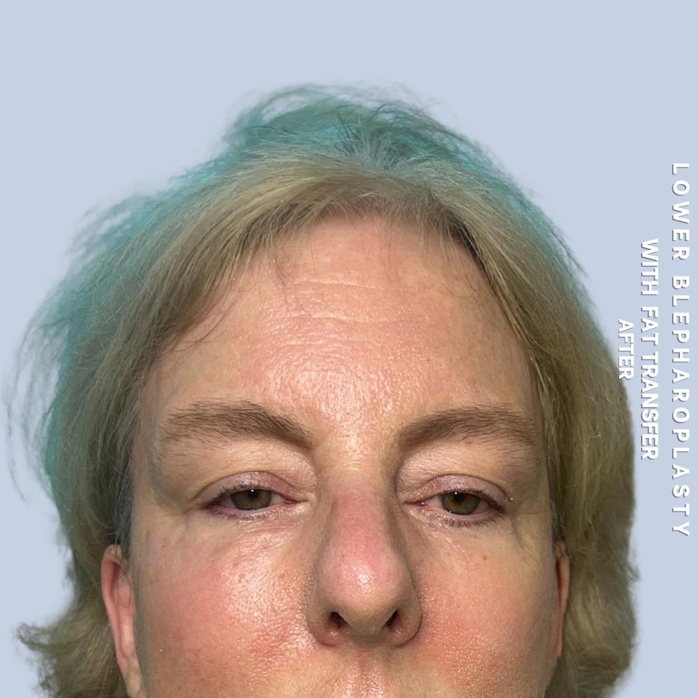 Eyes Before & After Gallery - Patient 227892 - Image 2