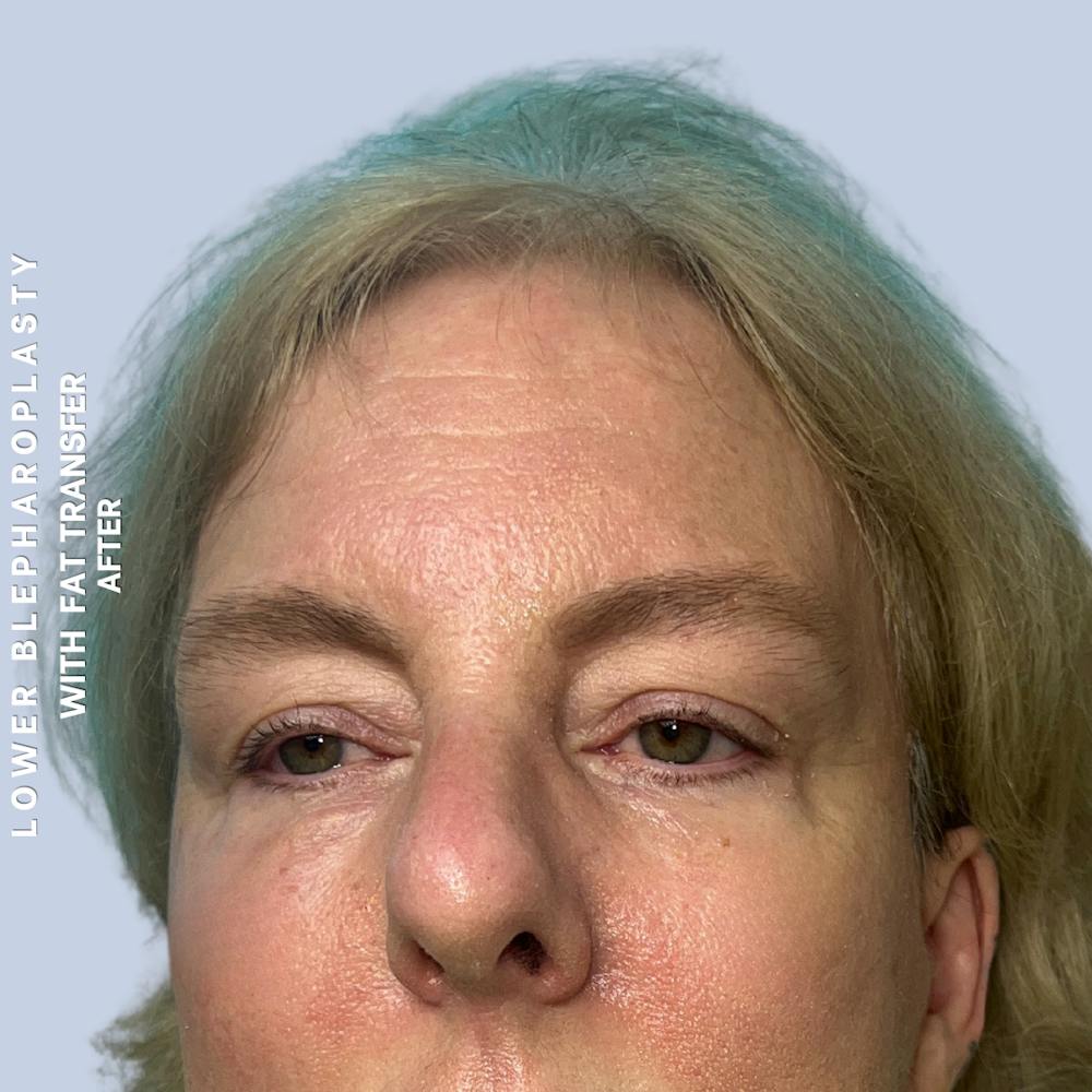Eyes Before & After Gallery - Patient 227892 - Image 4