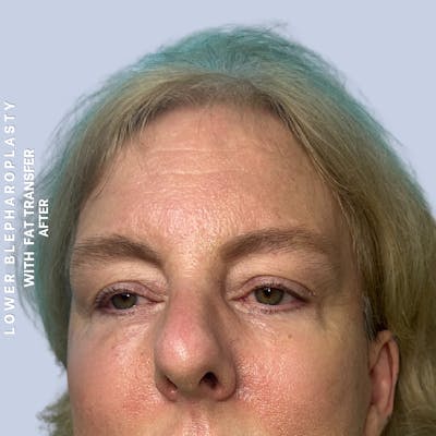 Eyes Before & After Gallery - Patient 227892 - Image 4