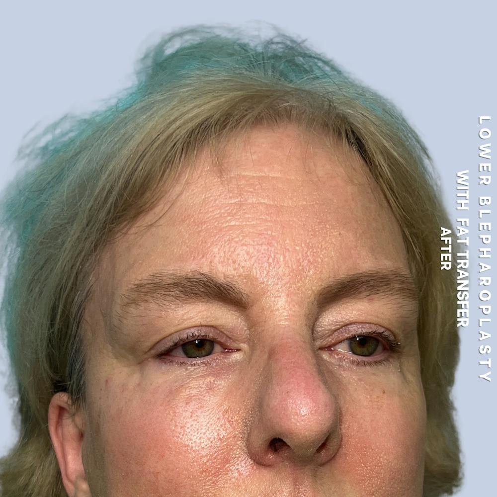Eyes Before & After Gallery - Patient 227892 - Image 6