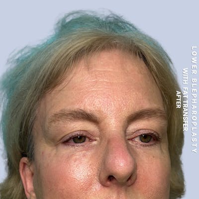 Eyes Before & After Gallery - Patient 227892 - Image 6