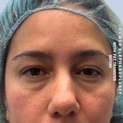 Eyes Before & After Gallery - Patient 334375 - Image 1