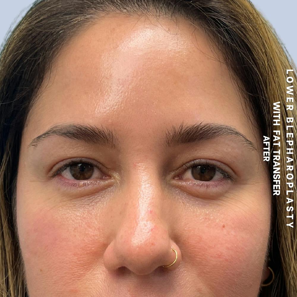 Eyes Before & After Gallery - Patient 334375 - Image 2
