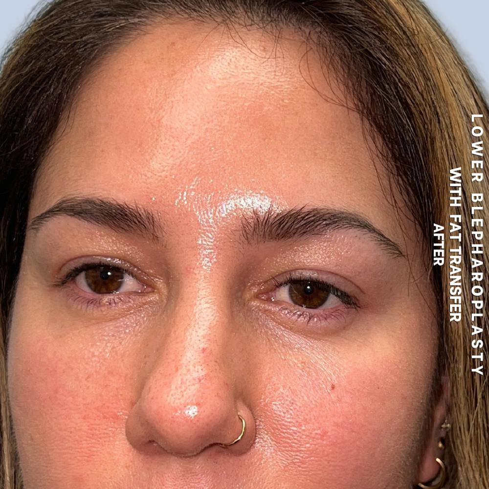 Eyes Before & After Gallery - Patient 334375 - Image 4