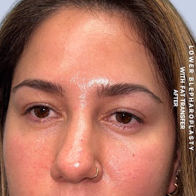 Eyes Before & After Gallery - Patient 334375 - Image 4
