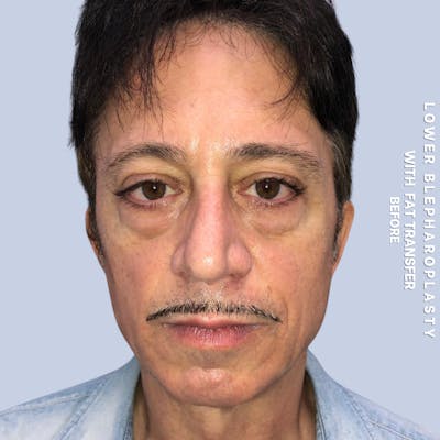 Eyes Before & After Gallery - Patient 108744016 - Image 1