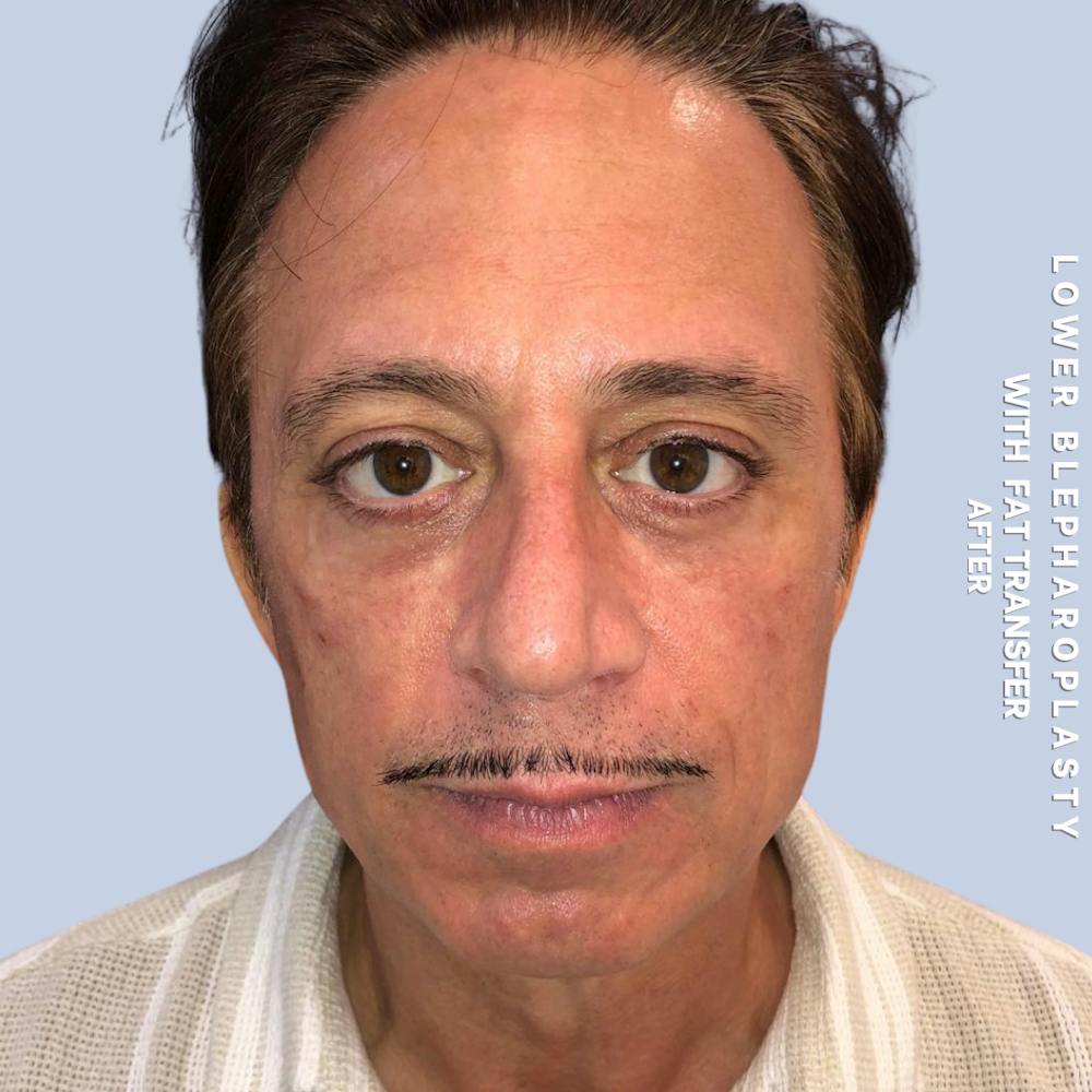 Eyes Before & After Gallery - Patient 108744016 - Image 2
