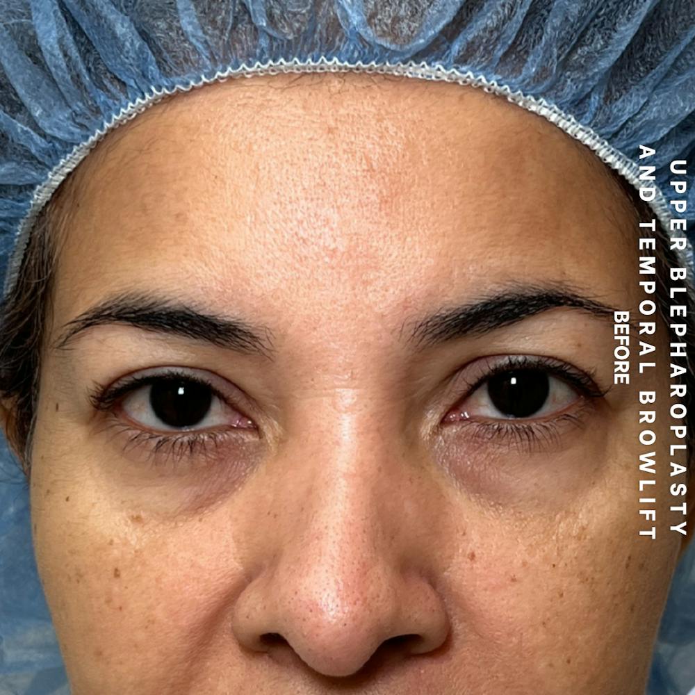 Eyes Before & After Gallery - Patient 354091 - Image 1