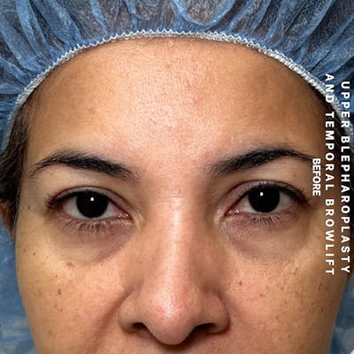 Eyes Before & After Gallery - Patient 354091 - Image 1