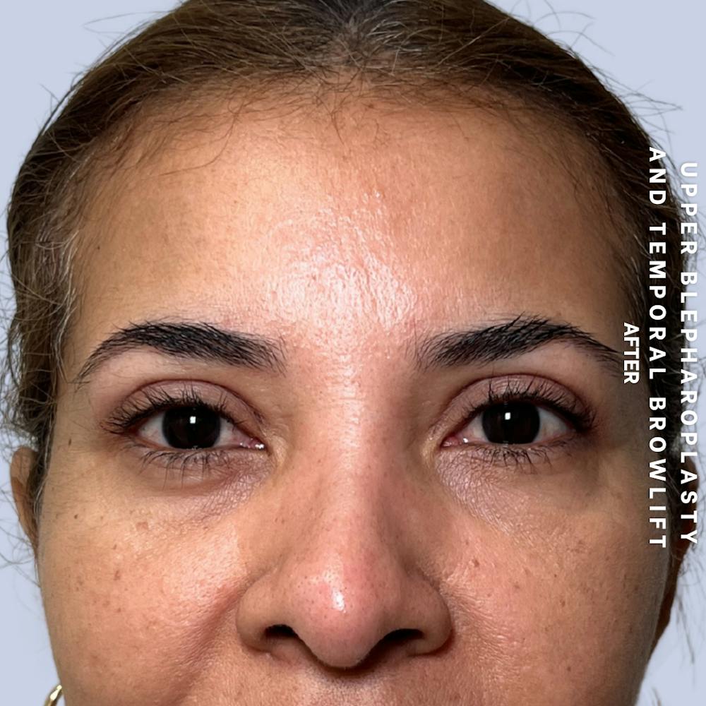 Eyes Before & After Gallery - Patient 354091 - Image 2