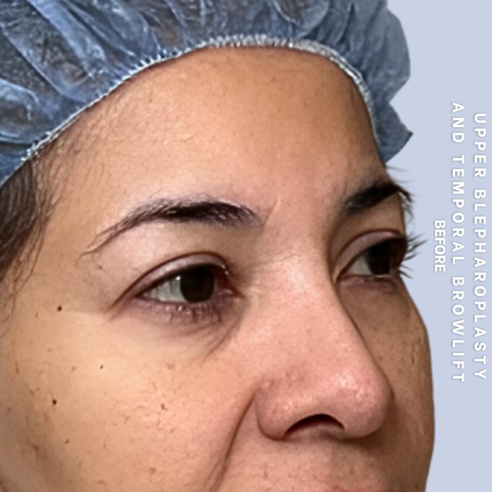 Eyes Before & After Gallery - Patient 354091 - Image 3