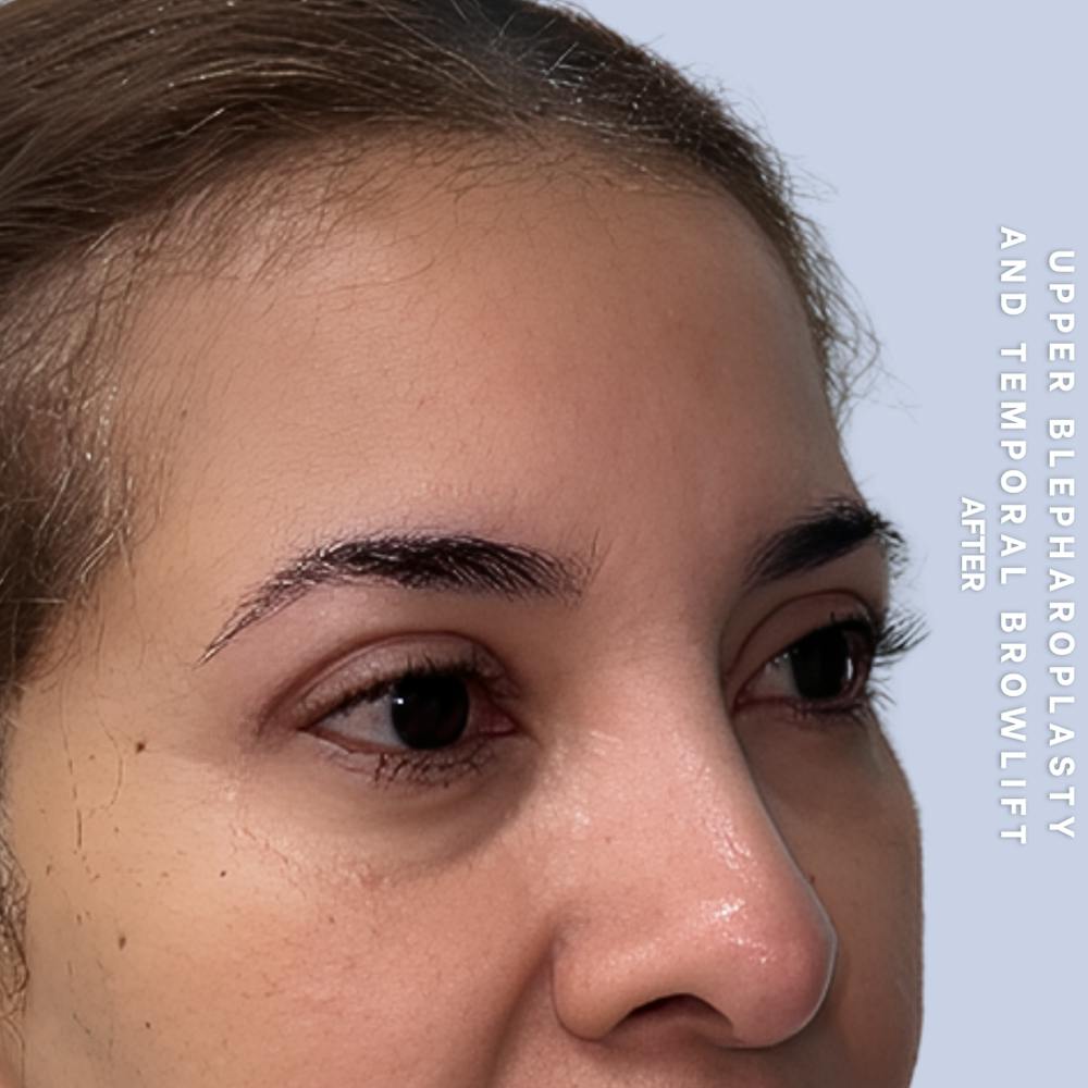 Eyes Before & After Gallery - Patient 354091 - Image 4
