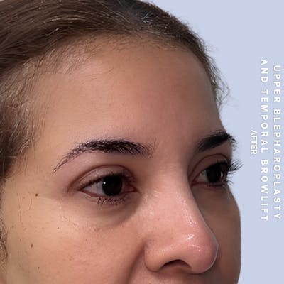 Eyes Before & After Gallery - Patient 354091 - Image 4