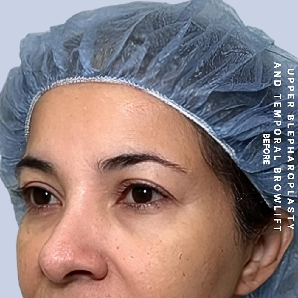 Eyes Before & After Gallery - Patient 354091 - Image 5