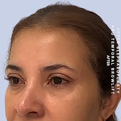 Eyes Before & After Gallery - Patient 354091 - Image 6