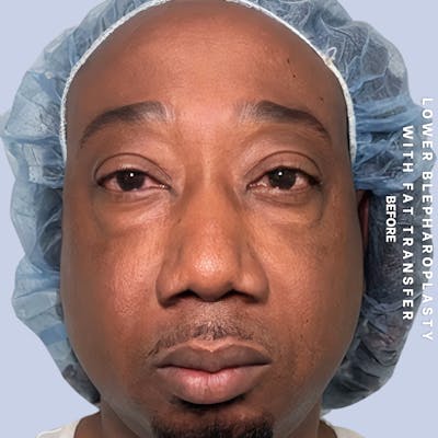 Eyes Before & After Gallery - Patient 587640 - Image 1