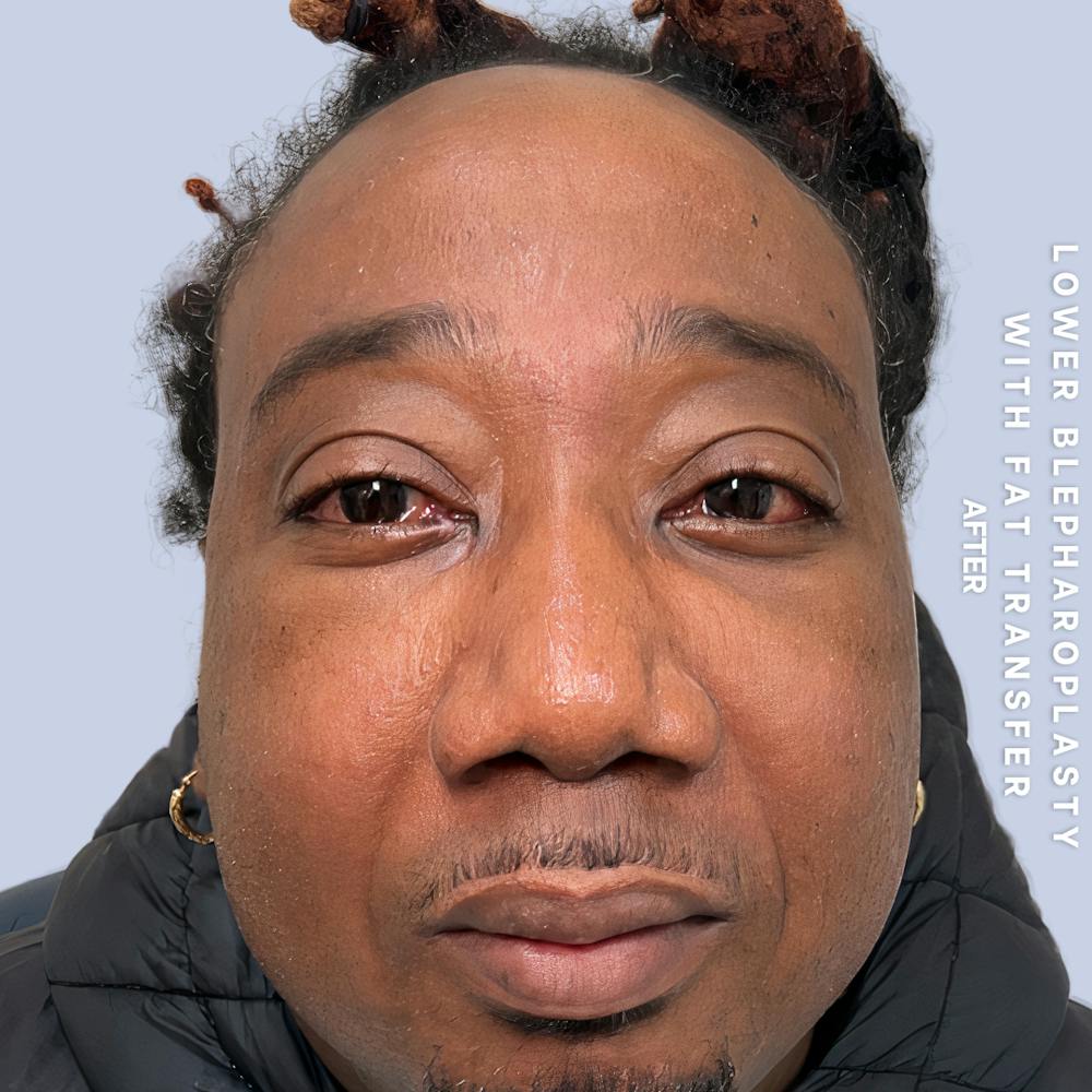Eyes Before & After Gallery - Patient 587640 - Image 2