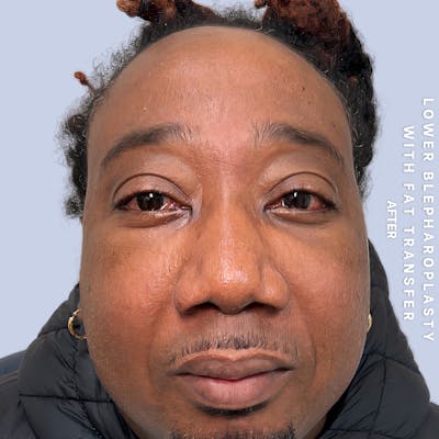 Eyes Before & After Gallery - Patient 587640 - Image 2