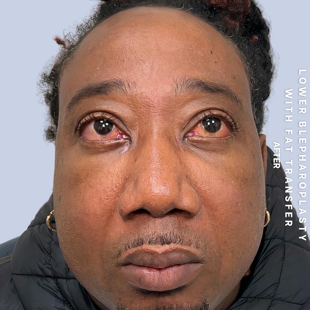 Eyes Before & After Gallery - Patient 587640 - Image 4