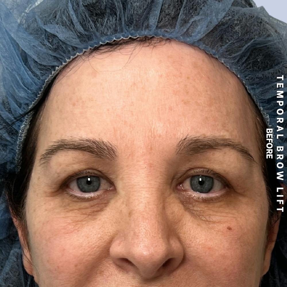 Eyes Before & After Gallery - Patient 422350 - Image 1