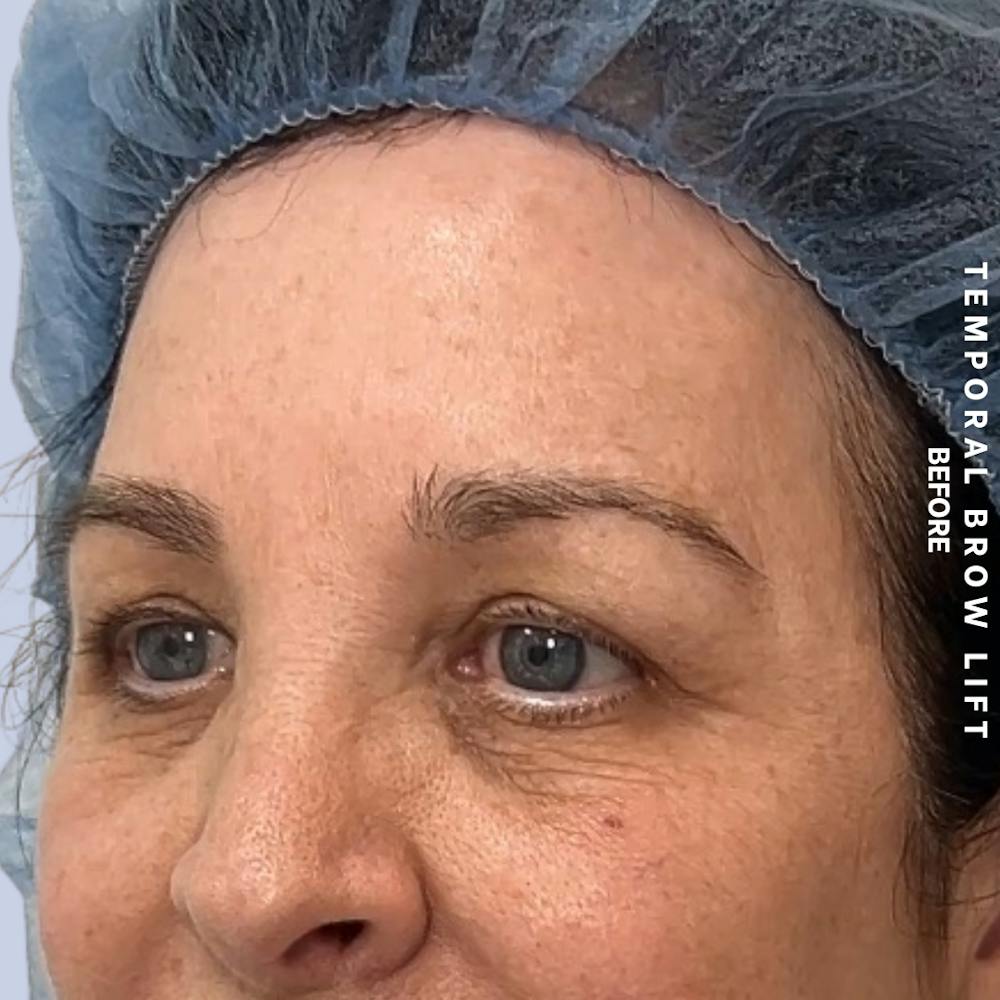 Eyes Before & After Gallery - Patient 422350 - Image 5