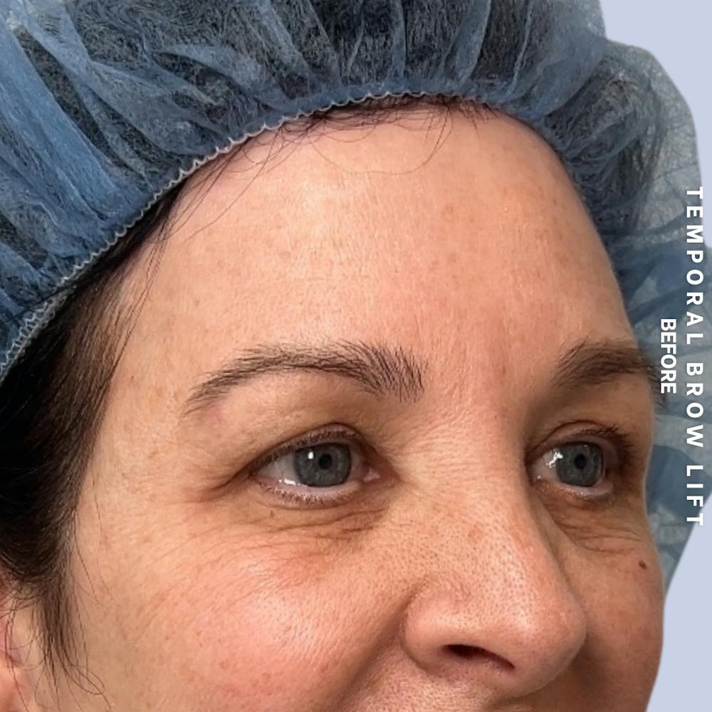 Eyes Before & After Gallery - Patient 422350 - Image 3