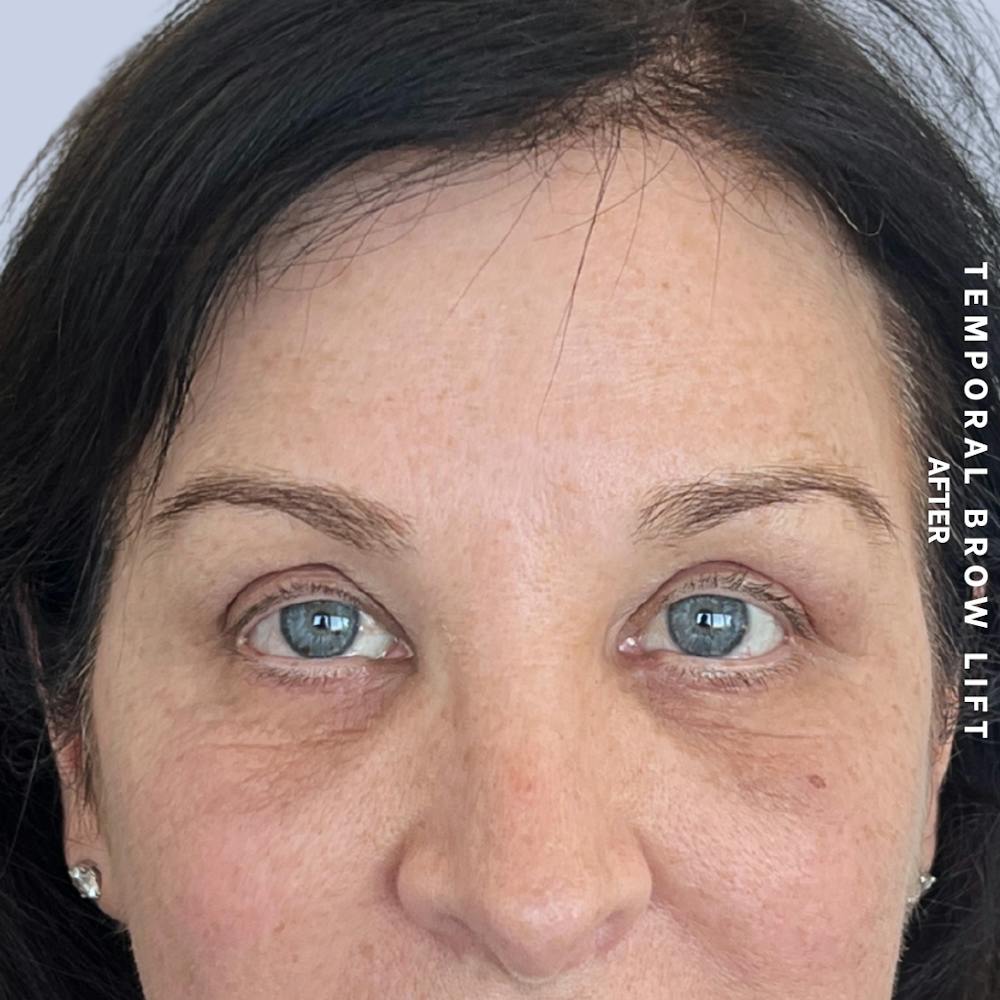 Eyes Before & After Gallery - Patient 422350 - Image 2