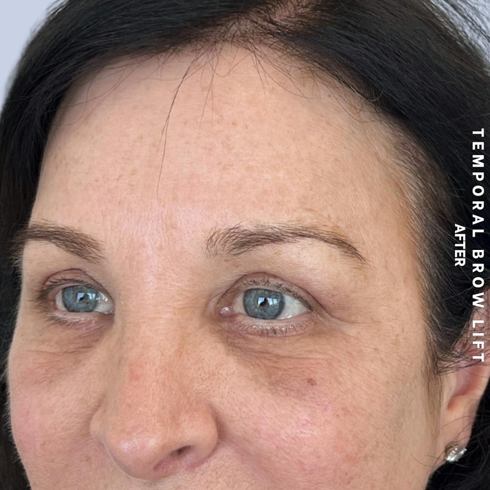 Eyes Before & After Gallery - Patient 422350 - Image 6