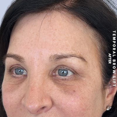 Eyes Before & After Gallery - Patient 422350 - Image 6
