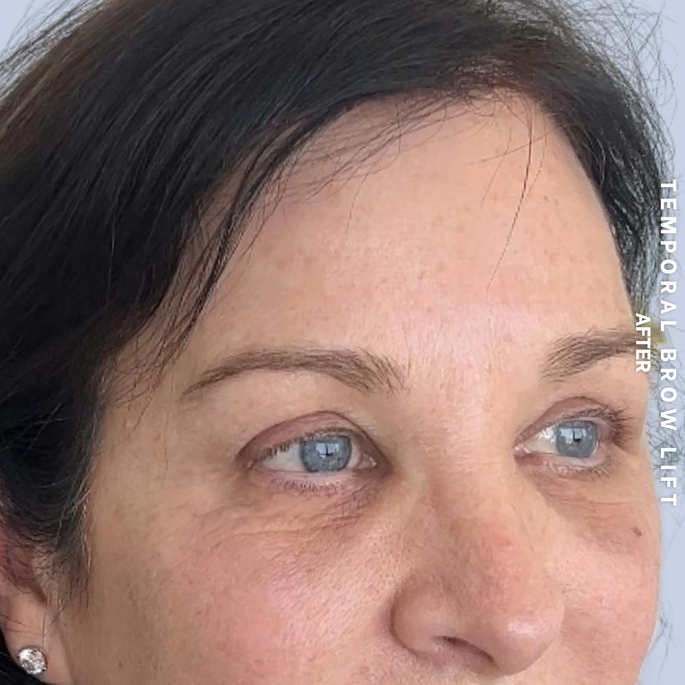 Eyes Before & After Gallery - Patient 422350 - Image 4