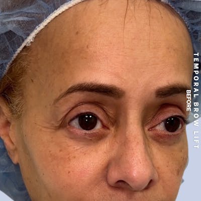 Eyes Before & After Gallery - Patient 696657 - Image 1