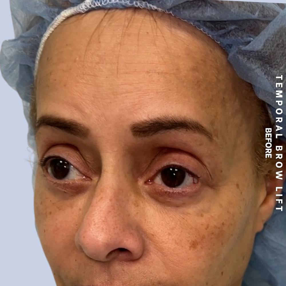 Eyes Before & After Gallery - Patient 696657 - Image 5