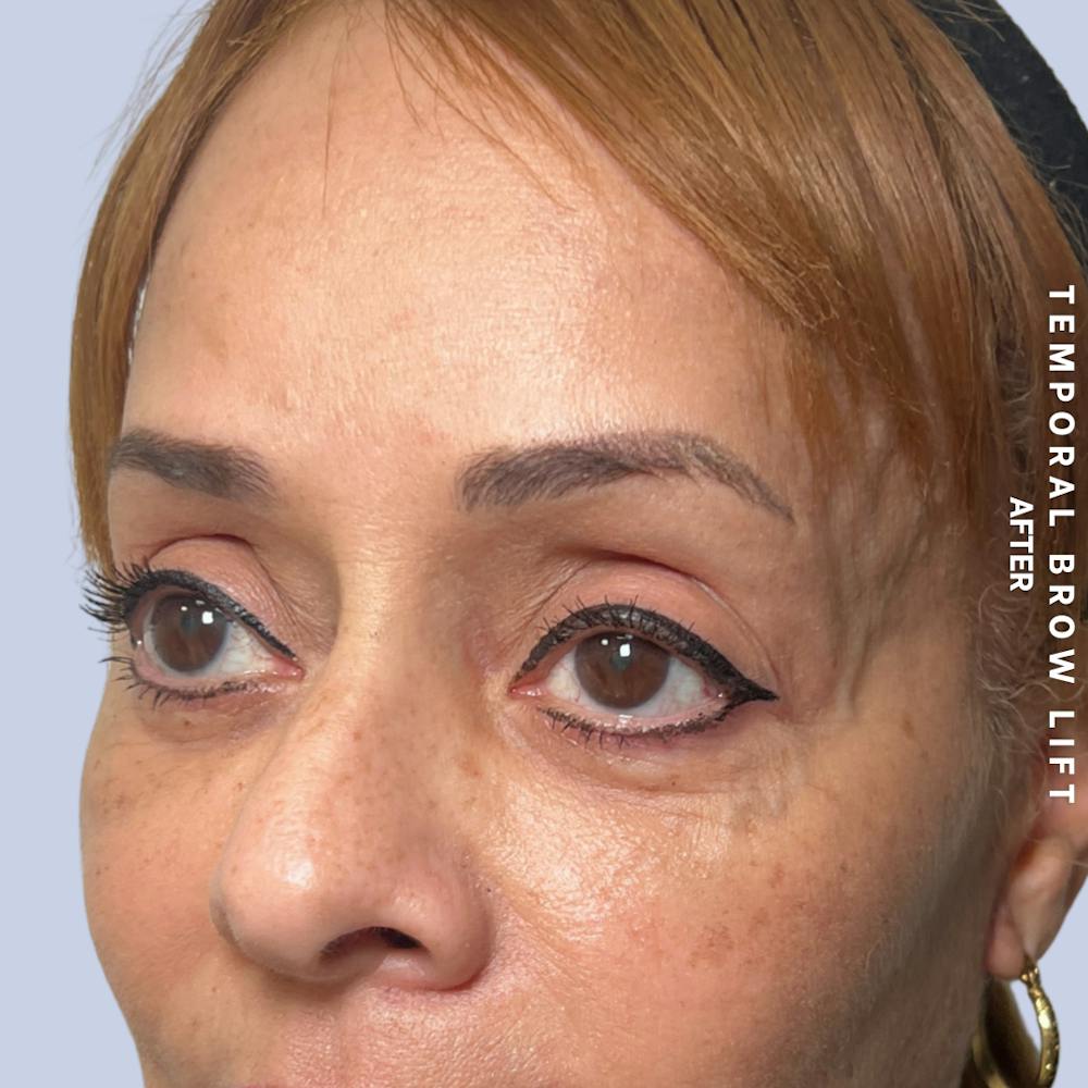 Eyes Before & After Gallery - Patient 696657 - Image 6