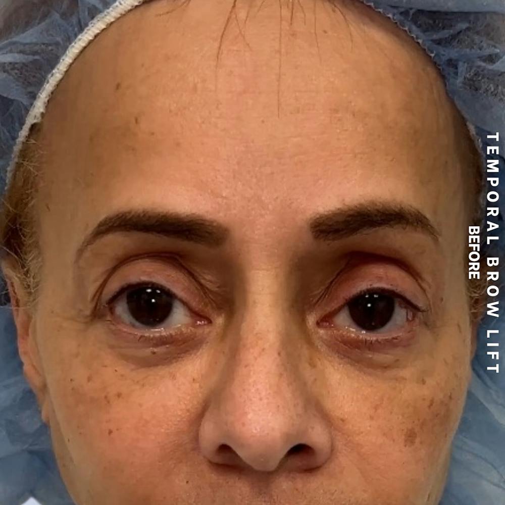 Eyes Before & After Gallery - Patient 696657 - Image 3