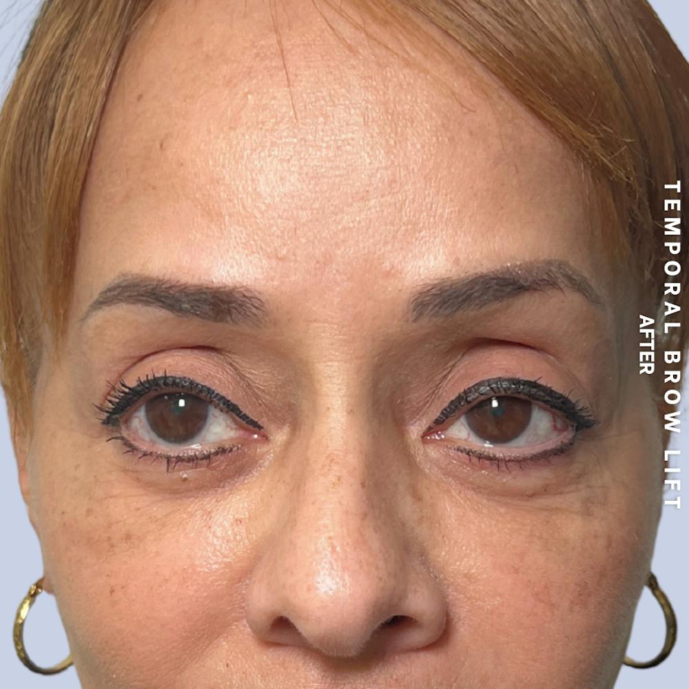 Eyes Before & After Gallery - Patient 696657 - Image 4