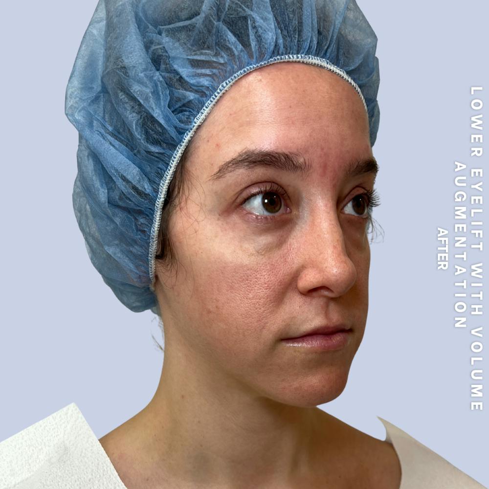 Eyes Before & After Gallery - Patient 136363 - Image 7