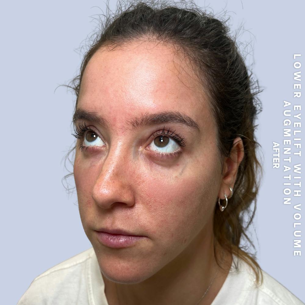 Eyes Before & After Gallery - Patient 136363 - Image 4
