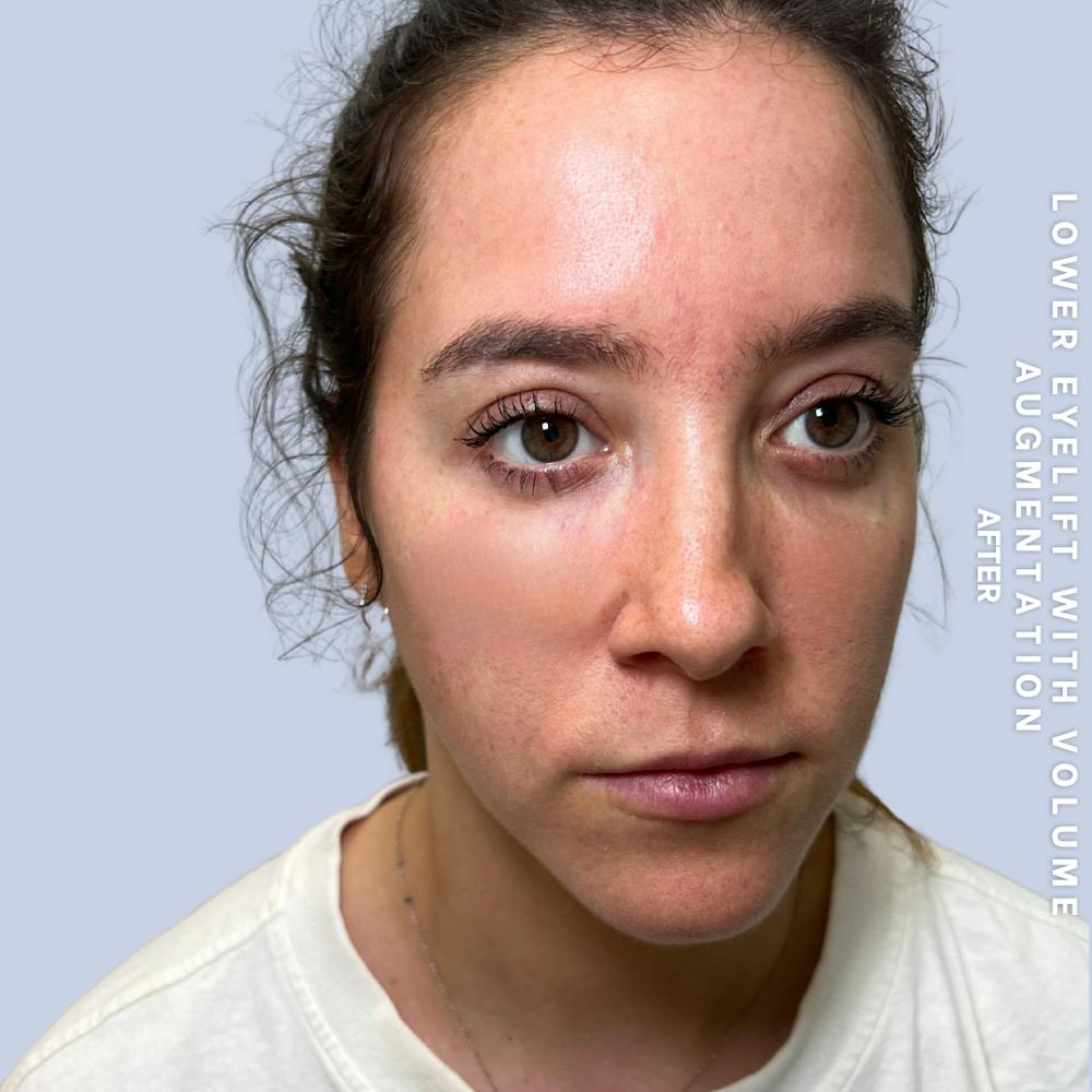 Eyes Before & After Gallery - Patient 136363 - Image 8
