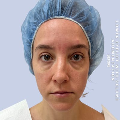 Eyes Before & After Gallery - Patient 136363 - Image 1