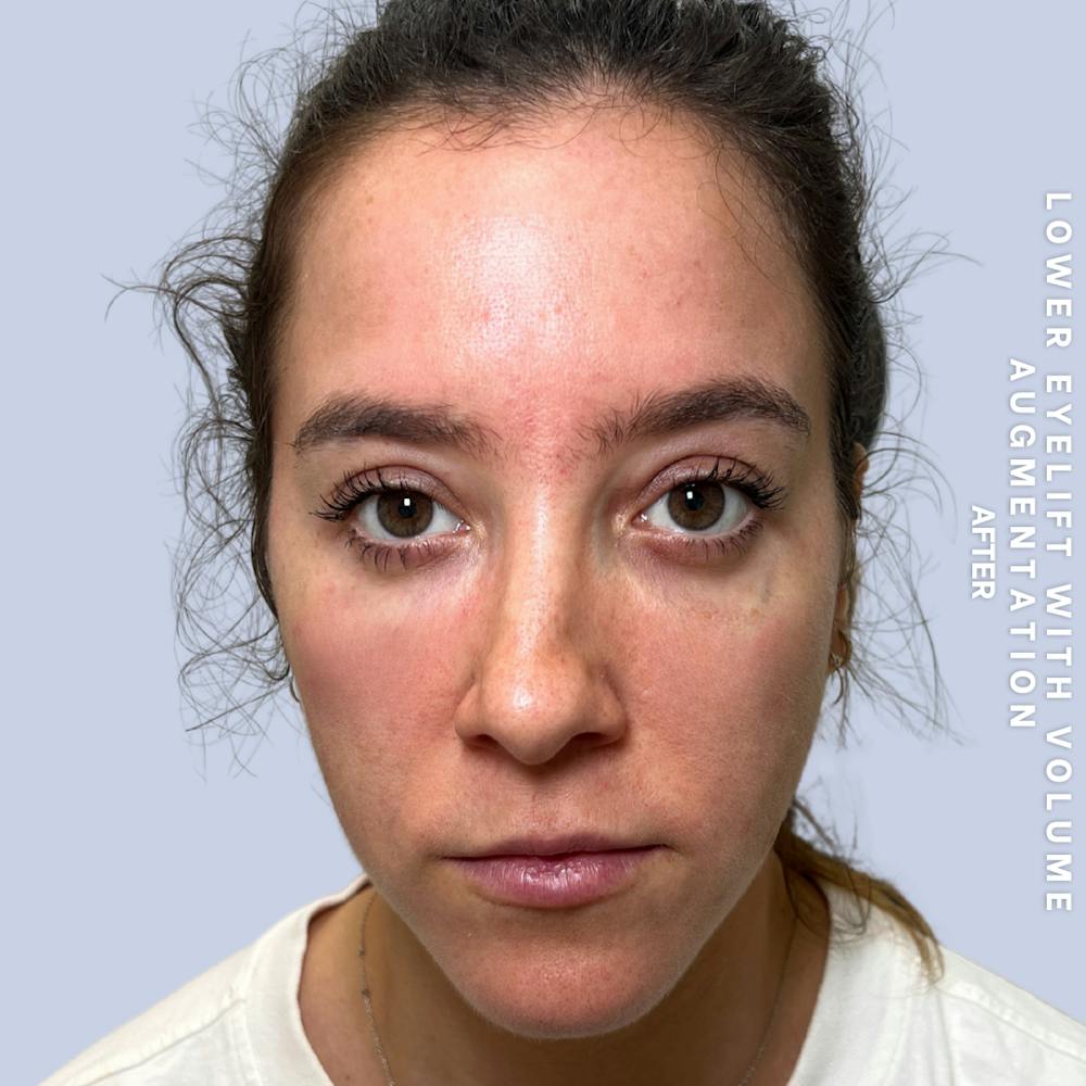 Eyes Before & After Gallery - Patient 136363 - Image 2