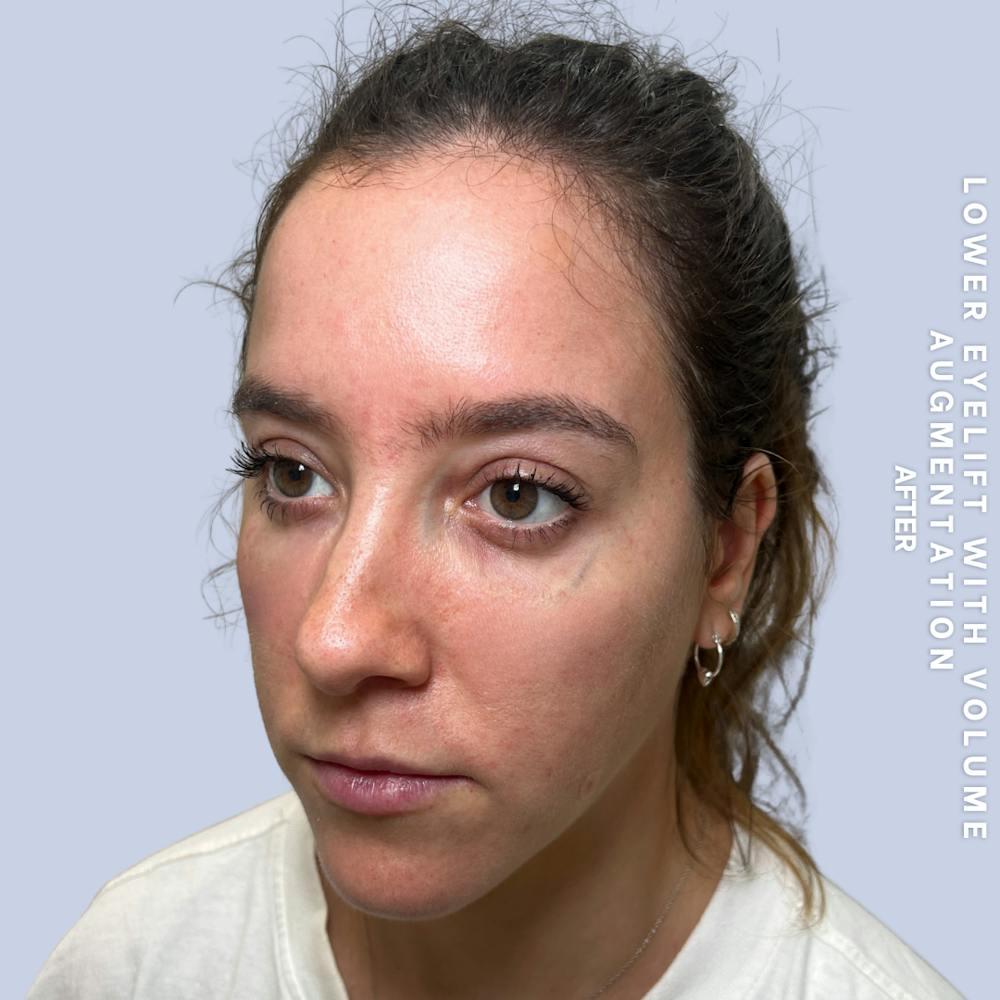 Eyes Before & After Gallery - Patient 136363 - Image 6