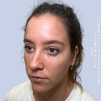 Eyes Before & After Gallery - Patient 136363 - Image 6