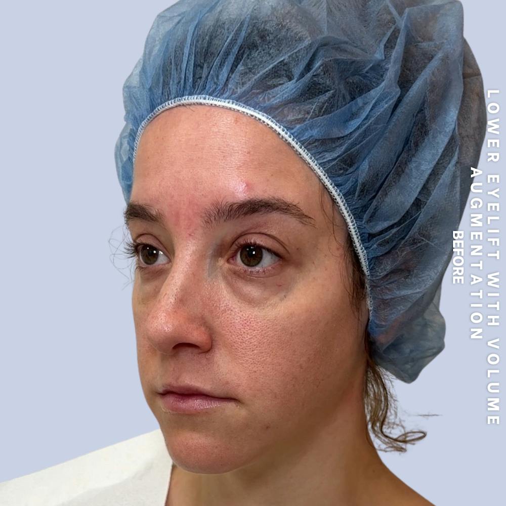 Eyes Before & After Gallery - Patient 136363 - Image 5