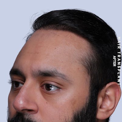 Hair Restoration Before & After Gallery - Patient 130289 - Image 10