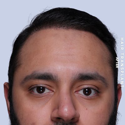 Hair Restoration Before & After Gallery - Patient 130289 - Image 2