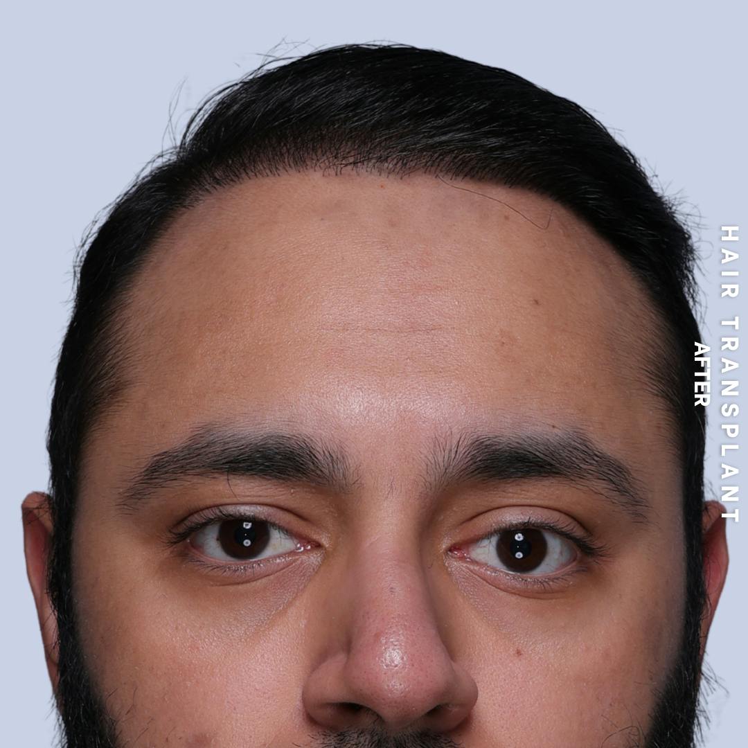 Hair Restoration Before & After Gallery - Patient 130289 - Image 2